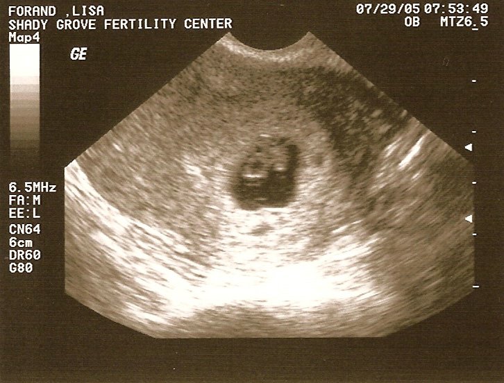 6-week sonogram.jpg