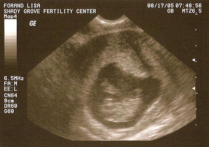 9-week sonogram.jpg